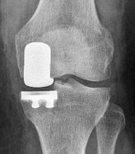 An implanted medial unicondylar replacement in X-ray from the front