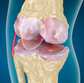 Schematic illustration of high-grade knee osteoarthritis