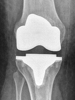 An implanted total knee replacement in the X-ray from the front