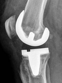X-ray of an implanted total knee replacement from the side