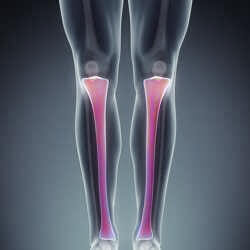 Osteotomy Osteotomy