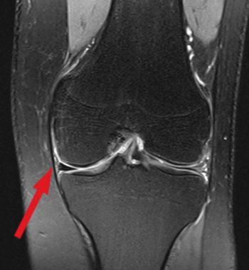 Illustration of an intact medial collateral ligament (MCL) in MRI
