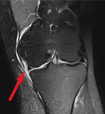 Illustration of an medial collateral ligament injury in MRI