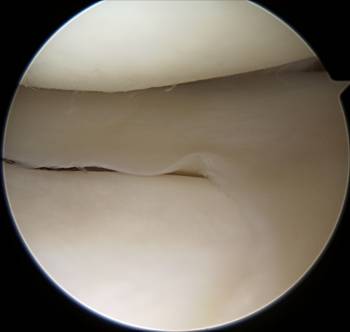 Image of an intact meniscus in an arthroscopy