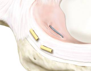 Meniscus suture with the all-inside technique