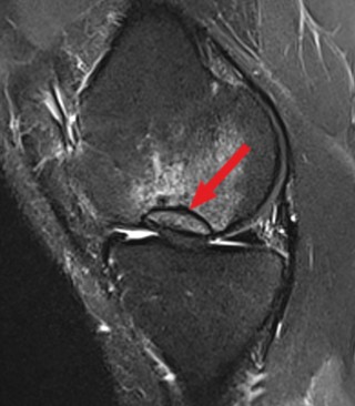 An osteochondritis dissecans lesion on MRI marked with an arrow