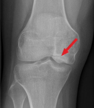 An osteochondritis dissecans lesion in the knee X-ray marked with an arrow